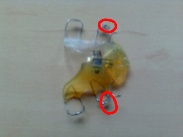 Modified Palate Expander Modified Palate Expander
