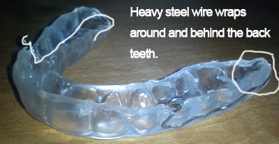 Nightguard for TMJ Nightguard for TMJ