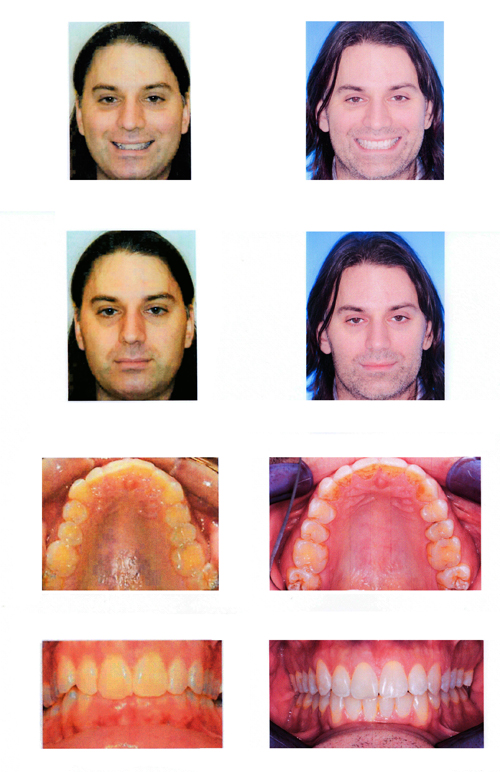 TMJ Before-and-After TMJ Before-and-After