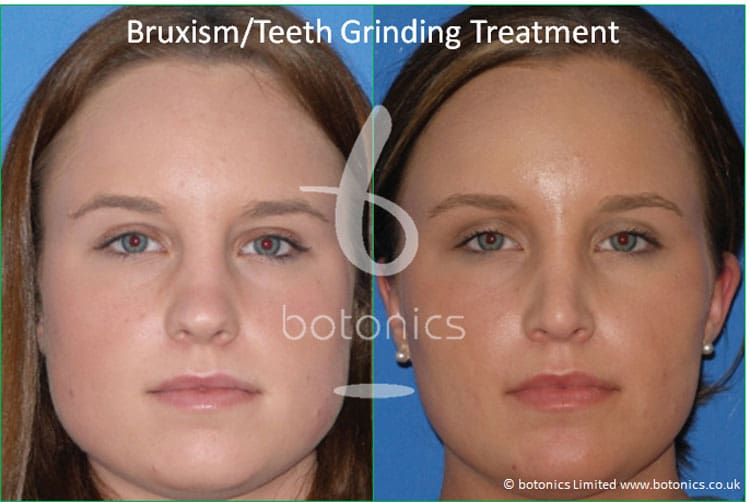 bruxism_botox_teeth_grinding_jaw_clenching_masseter_jaw_reduction_treatment_before_and_after_botonics_1.jpg