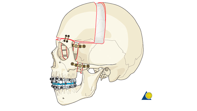 monobloc-advancement-procedure-demonstration-craniofacial-surgical-management-revised-july-2017-780x439.jpg