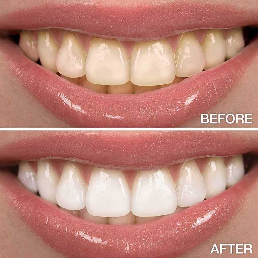 before-after-teeth-whitening.jpg