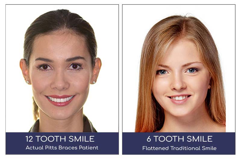 6-vs-12-tooth-smile-adult-braces.jpg