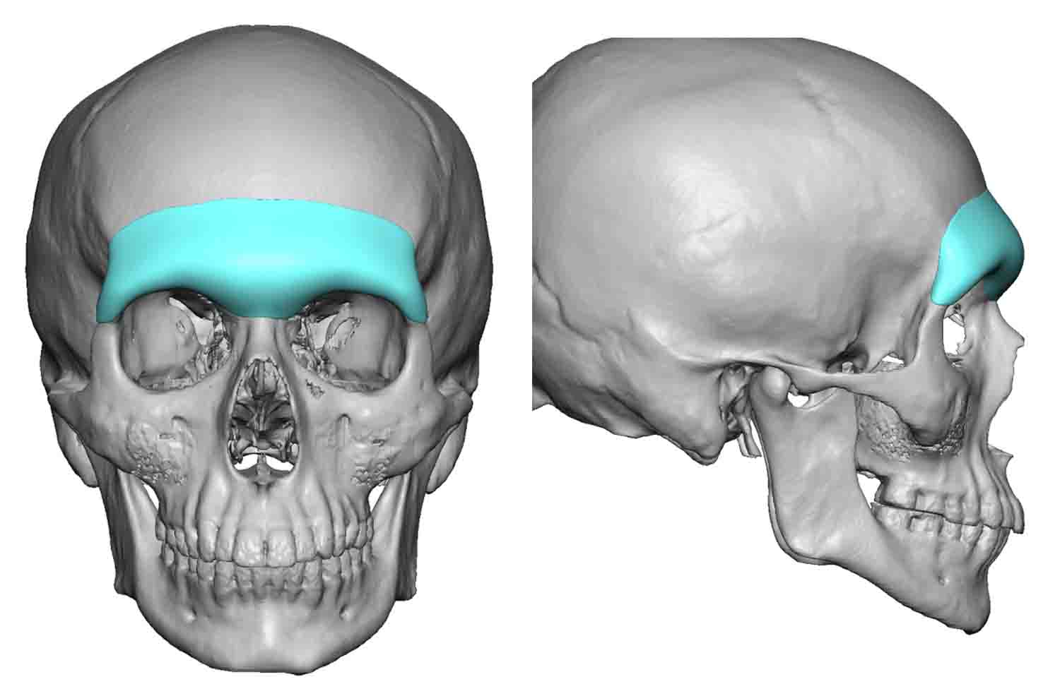 2-Male-Custom-Brow-Bone-Imnplant-design-Dr-Barry-Eppley-Indianapolis-.jpg