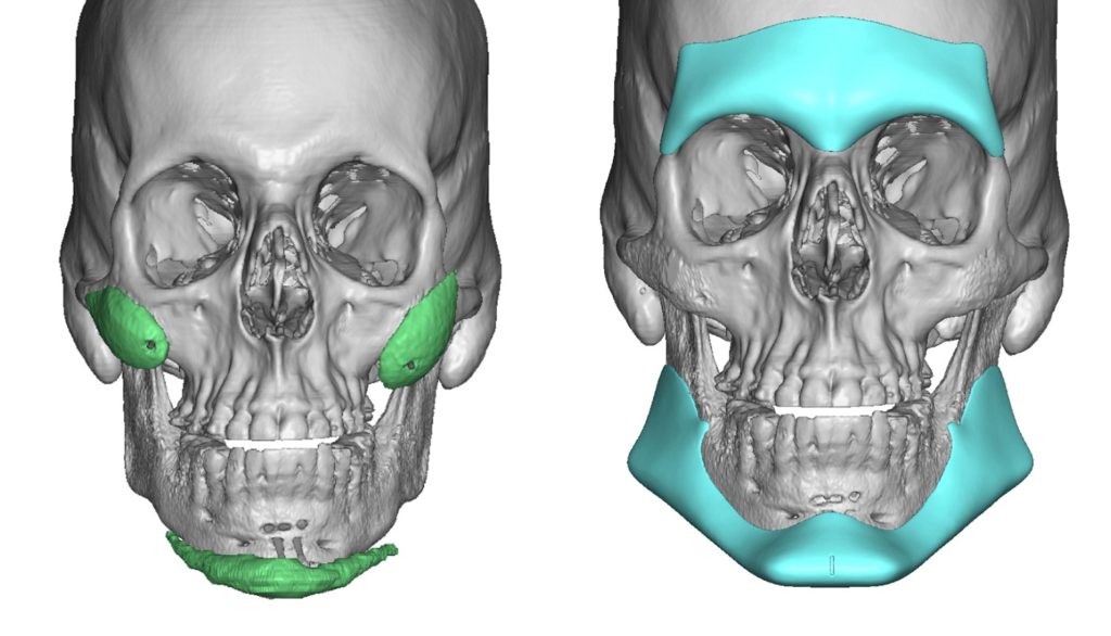 22-Large-Custom-Jawline-Implant-and-Brow-one-Implant-designs-front-view-1024x586.jpg