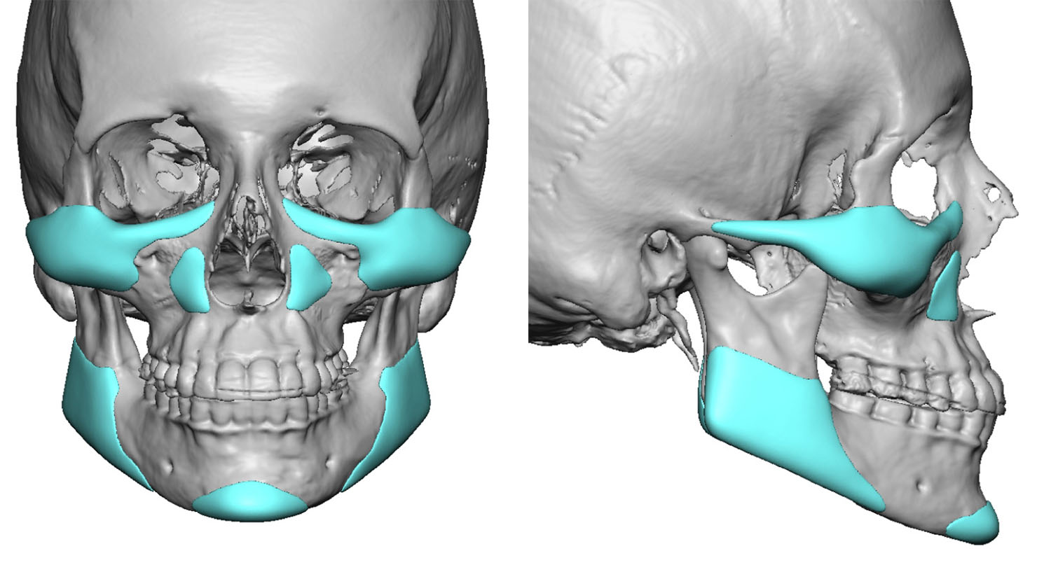 3-Female-petiete-custom-chin-implant-design-Dr-Barry-Eppley-Indianapolis.jpg