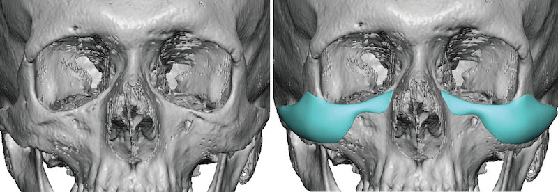 Custom-Infraorbital-Malar-Implants-design-front-view-Dr-Barry-Eppley-Indianapolis.jpeg