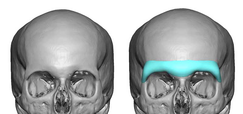 www.eppleycustomfacialimplants.com