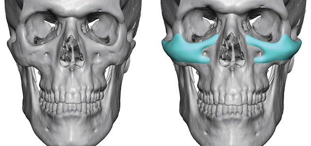 Male-Custom-Infraorbital-Malar-Implants-design-front-view-Dr-Barry-Eppley-Indianapolis.jpg