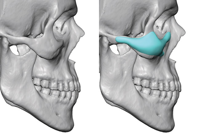 Male-Custom-Infraornital-Malar-Implants-design-side-view.jpg