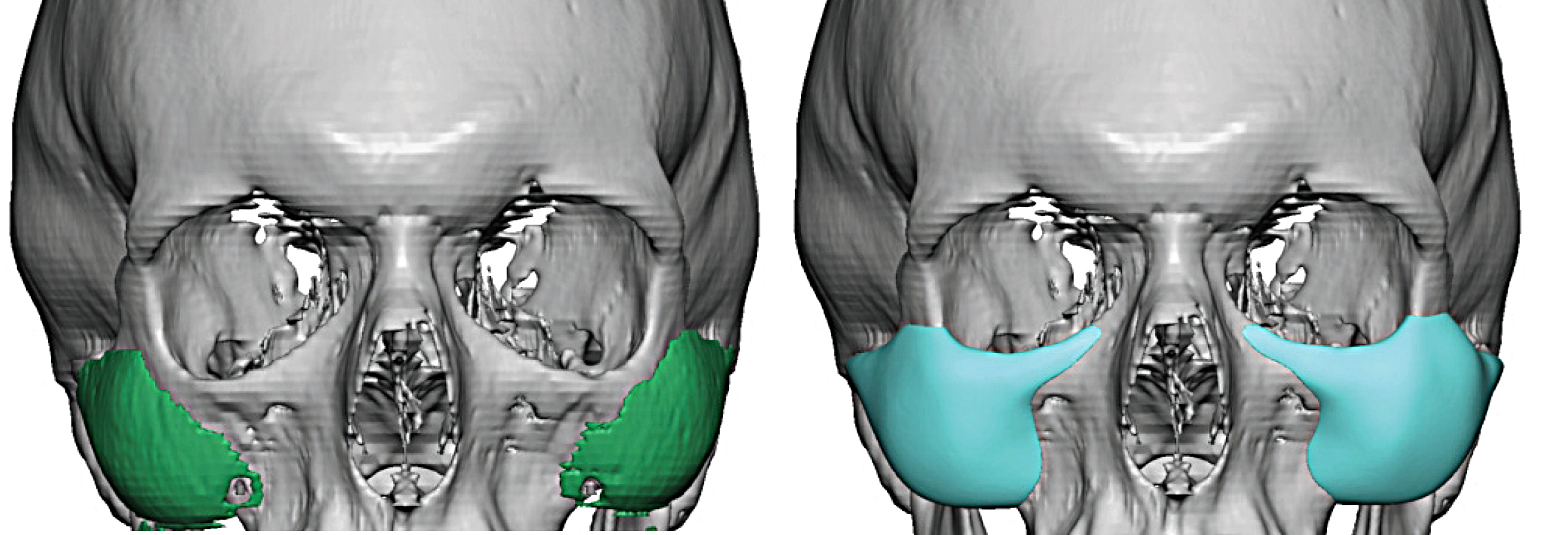 Custom-Infraorbital-Malar-Implant-Replacement-designs-front-view-Dr-Barry-Eppley-Indianapolis.jpg