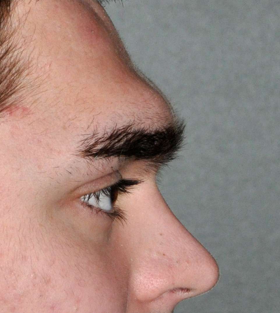 Forehead-13a-male-brow-bone-reduction-before-Dr-Barry-Eppley-Indianapolis.jpg