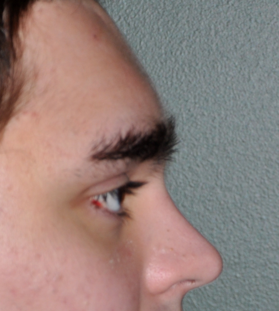 Forehead-13b-male-brow-bone-reduction-after-Dr-Barry-Eppley-Indianapolis.jpg