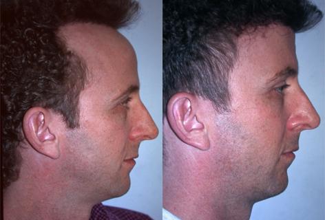 patient-13941-hair-line-lowering-before-after-1.jpg