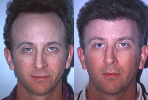 patient-13941-hair-line-lowering-before-after.jpg