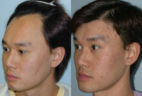 patient-14096-hair-line-lowering-before-after-1.jpg