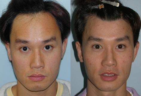 patient-14096-hair-line-lowering-before-after.jpg