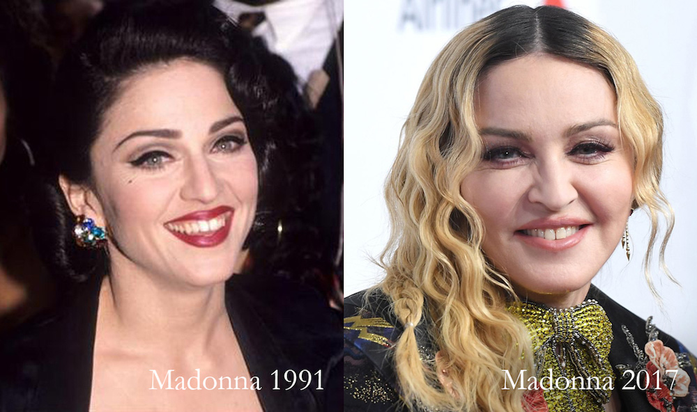 madonna-before-after-pillow-face-Dr-Siew.jpg