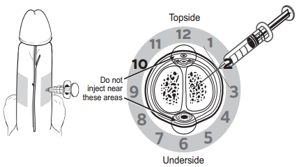 penile_injection_therapy-fig_3-en.png