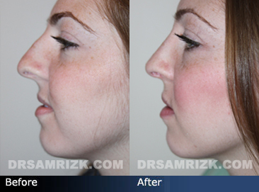 Resultado de imagen para nose bridge side profile