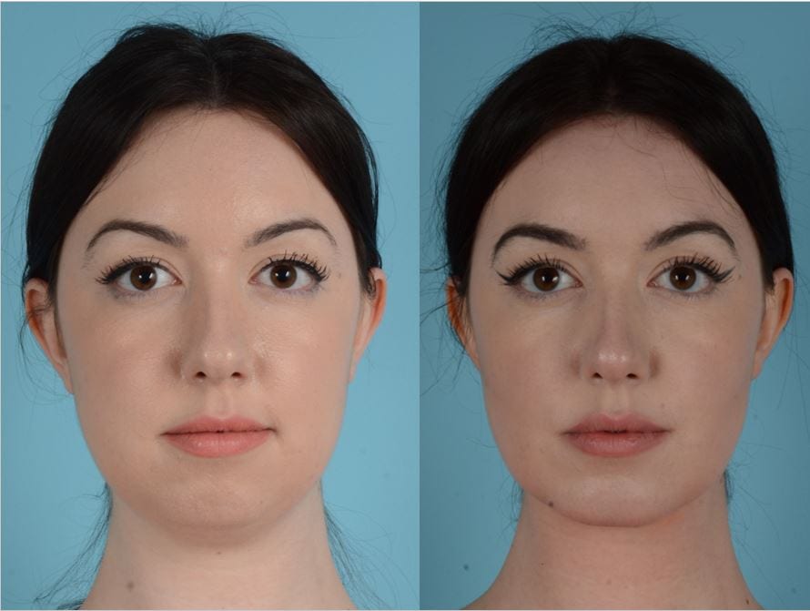 Buccal Fat Removal: Before and After - Richard Zoumalan