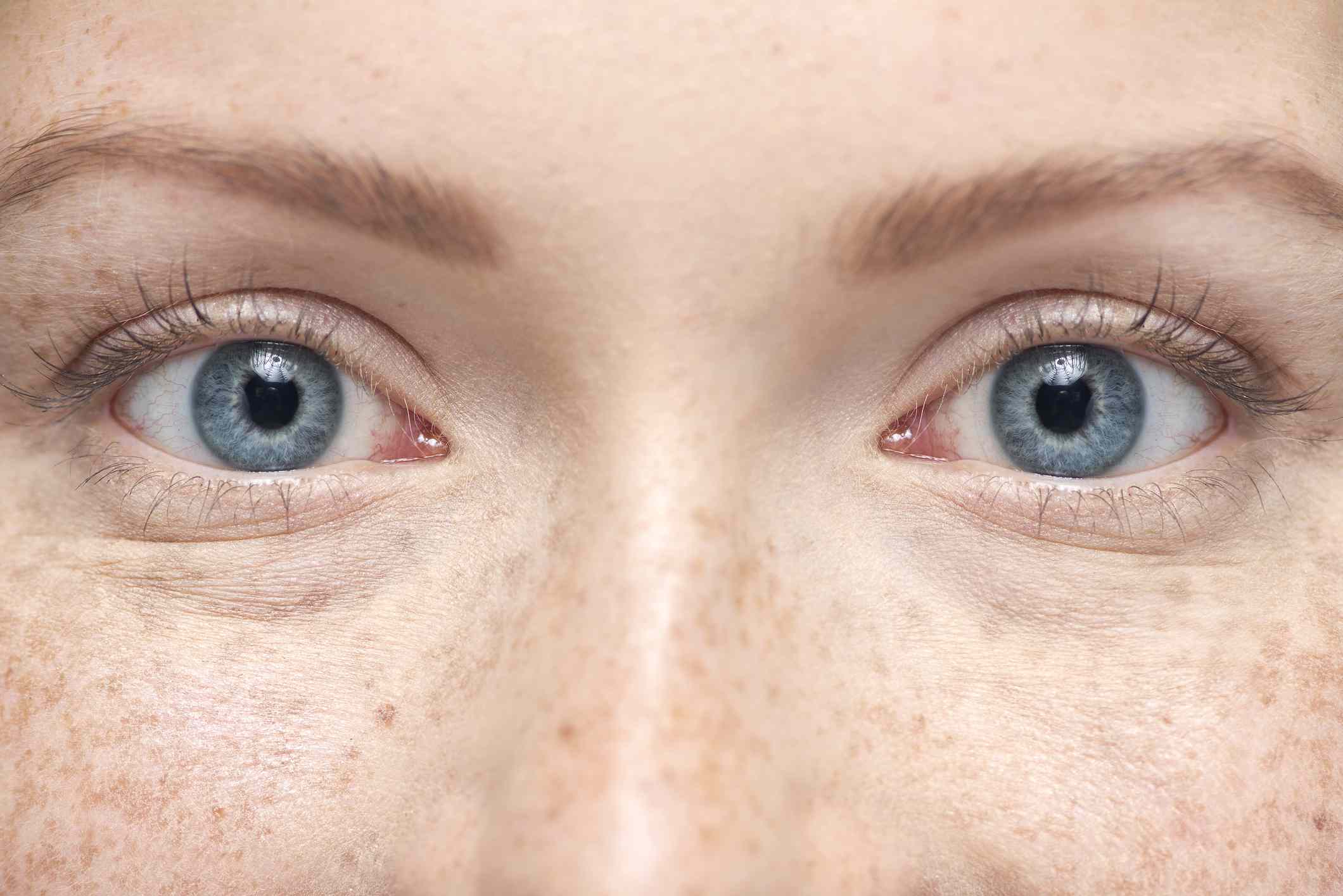 Blue Eyes: Anatomy, Genetics, Health Implications