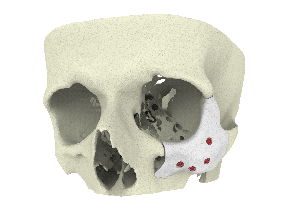 3D printed CT-Bone implant for zygoma augmentation